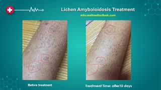 Successfull Lichen Amyloidosis Treatment Lichen Amyloidosis Cure 20192022 [upl. by Novaat923]