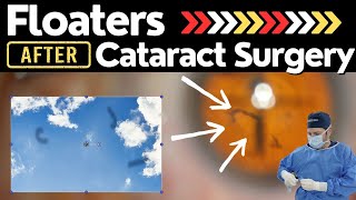 Cataracts amp Floaters [upl. by Janelle]