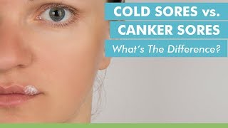 Cold Sores vs Canker Sores Whats The Difference [upl. by Oel]