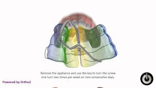 Upper Removable Expander Schwartz Appliance [upl. by Syla]