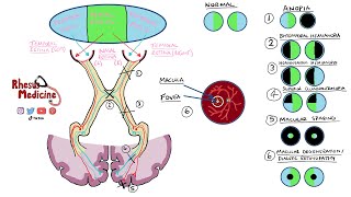 Visual Field Defects and Optic Nerve Pathway  Homonymous Hemianopia Bitemporal Hemianopia NEW 2020 [upl. by Thompson96]