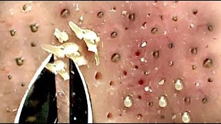 Best Satisfying Nose Plucking Blackheads Whiteheads Removal  Acne Treatment 20 [upl. by Vite100]