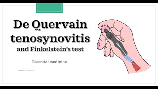 De Quervains tenosynovitis Essential medicine [upl. by Barth]