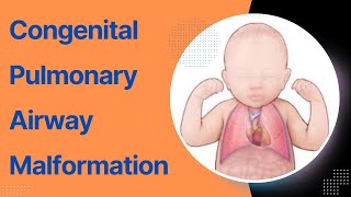 Congenital Pulmonary Airway Malformation CPAM  Causes Symptoms Diagnosis and Treatment [upl. by Belamy]