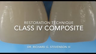 Class IV Composite Restoration  Restoration Technique [upl. by Noivert]