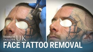 Watch This Man Have His Face Tattoo Removed From Laser Surgery  Business Insider [upl. by Nede]