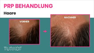 PRP Haare  Eigenbluttherapie bei Haarausfall  Dr Turkof  1060 Wien [upl. by Feinberg750]