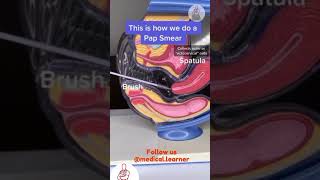 How to do pap smear  pap smear procedure  gynecology pap smear  medical learner  steps to do pap [upl. by Vidda]