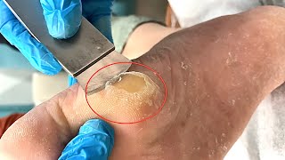 Callus removal from feetampFoot scraping dead skin【Xiao Yan pedicure】stress 809 [upl. by Jablon28]