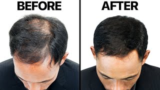 Finasteride Propecia For Hair Loss [upl. by Binnie]