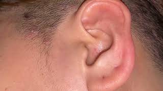 Ear cleaning with tweezers  ASMR Ear Cleaning  Deep Ear Cleaning ASMR [upl. by Zetrok]