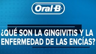 ¿Qué son la gingivitis y la enfermedad de las encías [upl. by Columba]