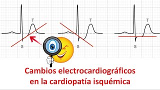 Cambios electrocardiográficos en la cardiopatía isquémica [upl. by Aicelaf]