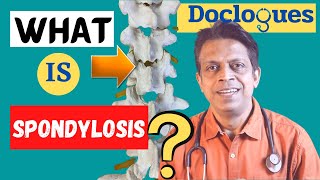 What is Spondylosis [upl. by Aneladdam938]