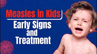 Measles Symptoms Treatment and Vaccination – Know all about it in this video [upl. by Gifferd223]