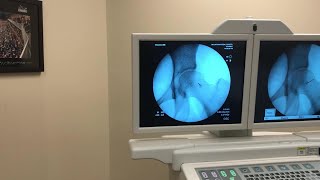 IntraArticular Injection of the Hip Under Fluoroscopic Guidance [upl. by Ebeohp]