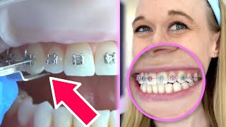 Putting Braces On My Teeth  Which Braces Color Did I Choose [upl. by Mavra]