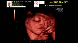 Anencephaly TM 3 [upl. by Marcy]