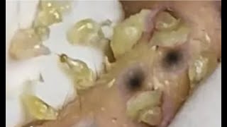 Deep blackhead extraction Cystic acne amp pimple popping 84 [upl. by Ahsieki780]