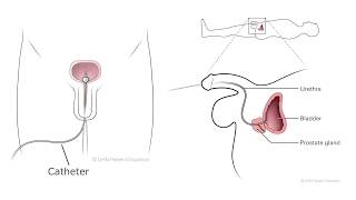 How to Care for Your Catheter Male at Home [upl. by Pelagi]