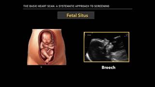 The Basic Fetal Heart Scan [upl. by Owiat]