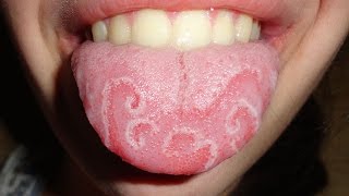 Geographic Tongue Natural Cure [upl. by Fitalludba]