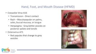 Viral Rashes in Children [upl. by Cates490]