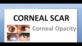 Ophthalmology 144 Acquired Corneal Scar Opacity Type Nebular Macular Leucoma Anterior Staphyloma [upl. by Sybila]