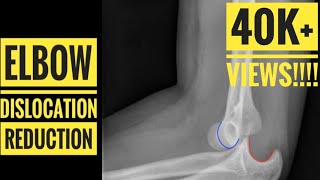 Elbow Dislocation Reduction Technique [upl. by Festa213]