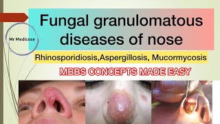 Fungal granulomatous diseases of nose  Rhinosporidiosis  Aspergillosis  Mucormycosis [upl. by Loss]