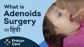 What is Adenoids Surgery in hindi [upl. by Trinidad295]