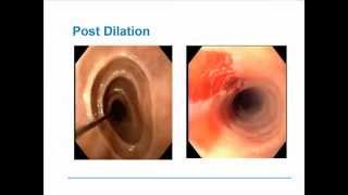 Eosinophilic Esophagitis [upl. by Mozza676]