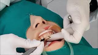 앞니레진 앞니레진 실시간 치료설명 Diastema resin closure real time anterior direct resin treatment [upl. by Amil]