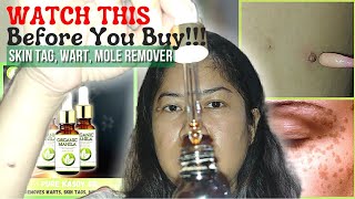 Removal Of Warts Moles Etc  Effective Skin Tag Remover  Organic Manila Pure Kasoy Oil [upl. by Vince]