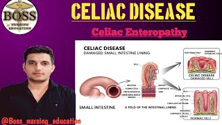 CELIAC DISEASE II CELIAC ENTEROPATHY II Gluten protein allergy pediatrics nursing medical [upl. by Adnaerb]