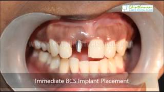 Gum Treatment Chennai  Periodontal Treatment Tamilnadu  Flap Surgery India [upl. by Anillek]