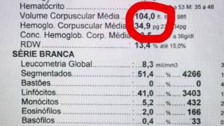 Anemia Megaloblastica Deficiencia de B12 e Folato [upl. by Abekam]