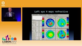 P Vinciguerra Biomechanical Characterization of Subclinical Keratoconus difficult case examples [upl. by Alasteir]