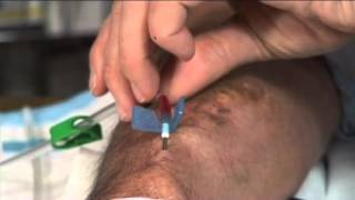 Bill Peckham doing selfdialysis amp cannulation via buttonhole method [upl. by Ayit]