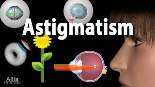 Astigmatism Types Causes Symptoms and Treatment Options Animation [upl. by Hannasus]