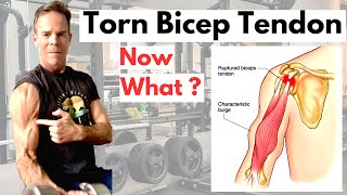 Torn or Ruptured Bicep Tendon What you need to know [upl. by Raines540]