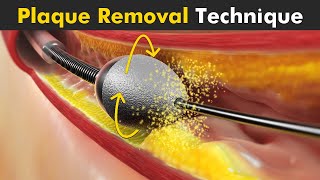 How Atherectomy is Performed  Removal Of Plaque From Arteries [upl. by Mena]