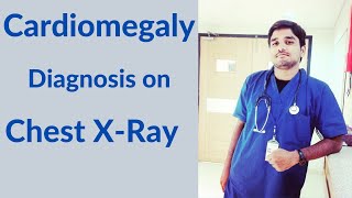 Cardiomegaly diagnosis on XRays [upl. by Notselrahc130]