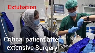 Extubation how to extubate critical patient after extensive Surgery without complications [upl. by Lola]