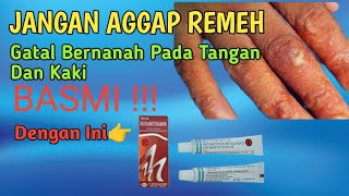 Obat Gatal Pada Kulit Tangan Bernanah  Paling Ampuh di Apotek [upl. by Rezeile]