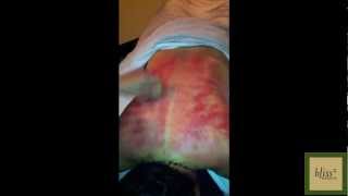 What Is Coining aka Scraping or Gua Sha  Massage Monday 81 [upl. by Nahtad]