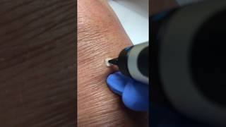 Wratjes verwijderen met cryopen [upl. by Erving502]