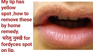 My lip has yellow and white spot what to do for cureFordyces spot on lips and its homes remedy [upl. by Polad]