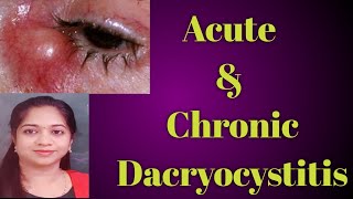 Dacryocystitis  Acute dacryocystitis Chronic Dacryocystitis Stages of Dcryocystitis Mucocele [upl. by Oratnek]