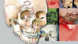 Craniomaxillofacial Buttresses Anatomy and Operative Repair [upl. by Cock]